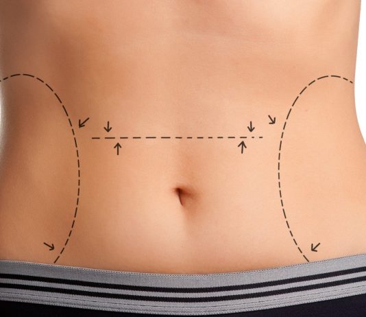 Avantajele abdominoplastiei!