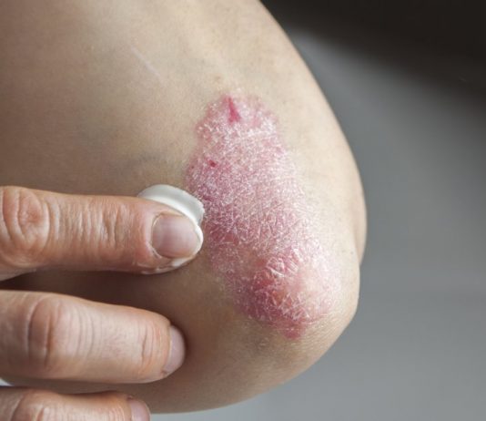 Psoriazisul