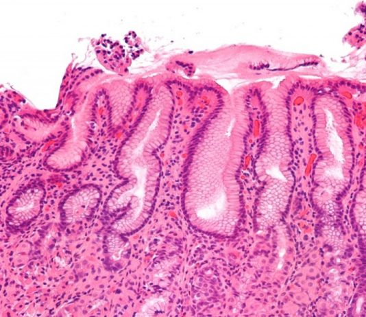 Cele 5 diferente dintre gastrita si gastroenterita