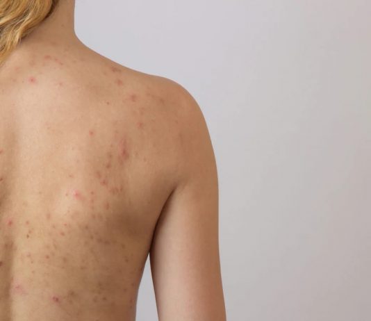 Cosuri pe corp, cunoaste-le semnificatia